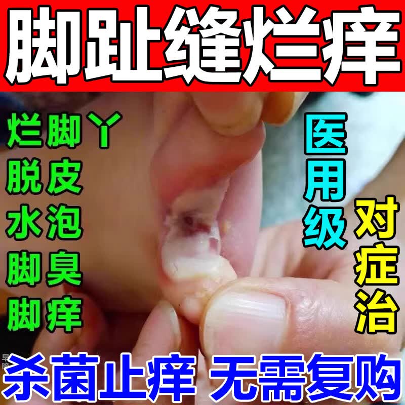 [韩都]克霉唑乳膏 脚气药止痒脱皮烂脚丫真菌感染根烂脚丫药脚趾缝烂痒专用的特新效期药治疗溃烂皮肤用药 1%*10g 1盒装 【医用脚气药】
