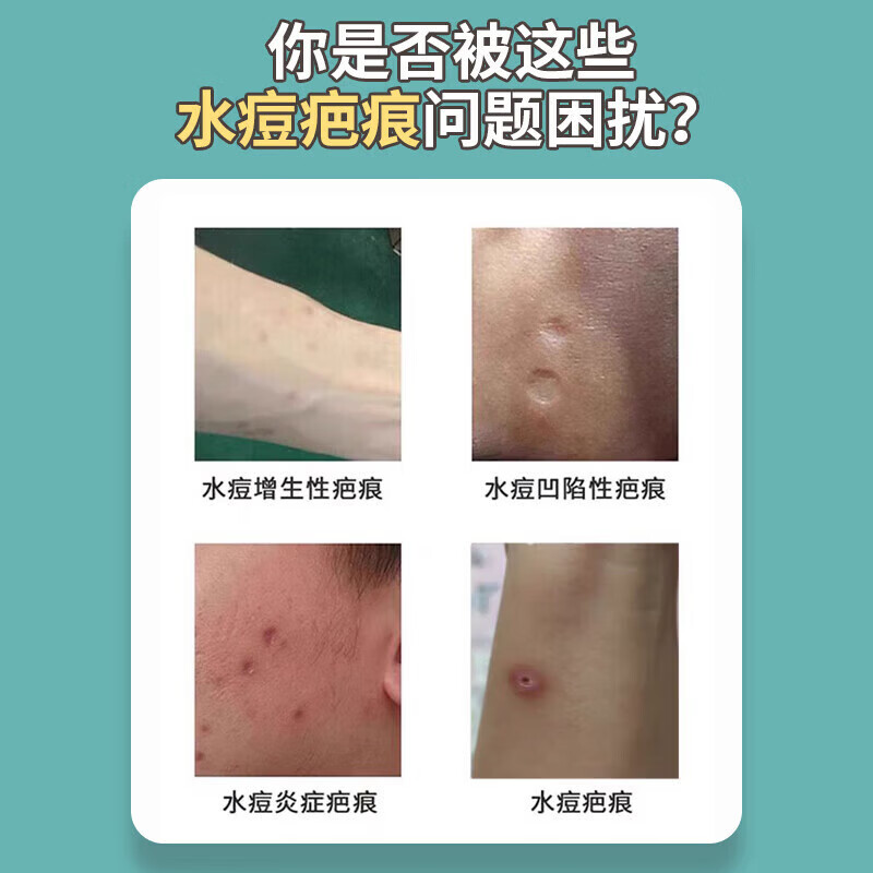 修正水痘疤痕修复凝胶水痘坑痘印复凹洞搭配生长因子祛陷疤膏儿童成人 单盒【体验装】
