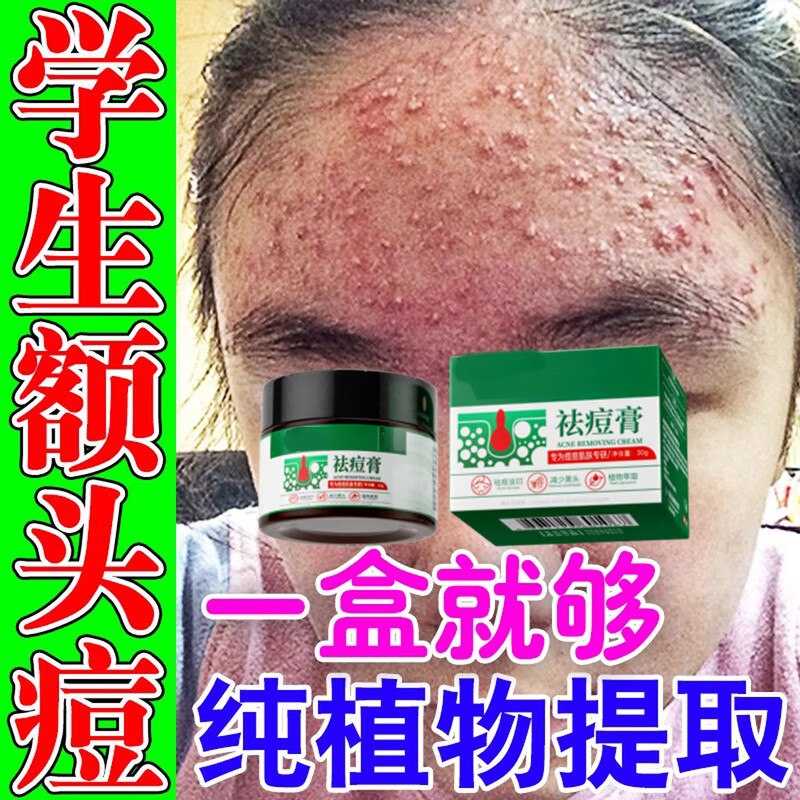 香港大药房祛痘膏和痘印坑修复痘痘和痘印青春痘消炎痤疮粉刺专用学生青少年 1瓶【买2送1】三盒一周期