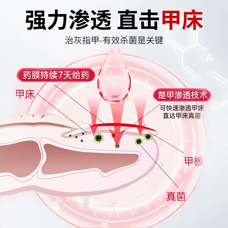 国药药材重度灰指甲100%特效专用的药特殊效专用抑菌液灰甲净套装 1盒装【1-2个推荐】 灰指甲100%特效专用的药第一名