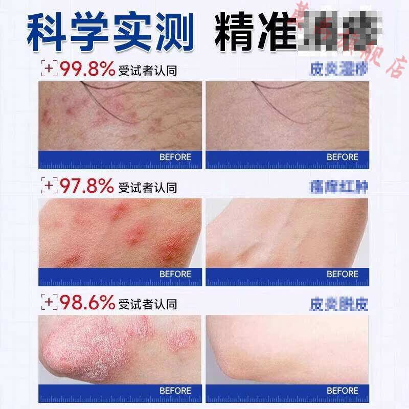 熏姿颜氟芬那酸酸丁酯乳膏湿疹止痒去外用顽固根皮炎成人特皮肤瘙痒非效 2支疗程装【轻度装 皮肤泛红 轻度皮炎 痘痘痘印】 官方直售