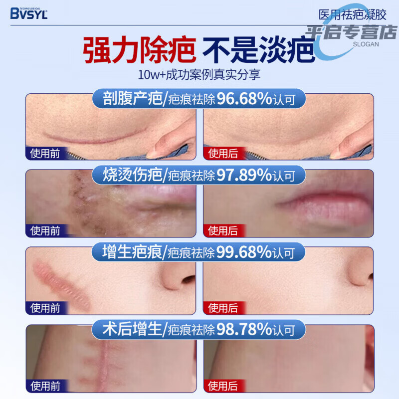 Dermatix倍舍舒痕5g疤痕凝胶美国进口医用手术增生除痕dermatix儿童成人 5支装【巩固装】买三赠二 98%的顾客选择 【官方旗舰 京质保障】