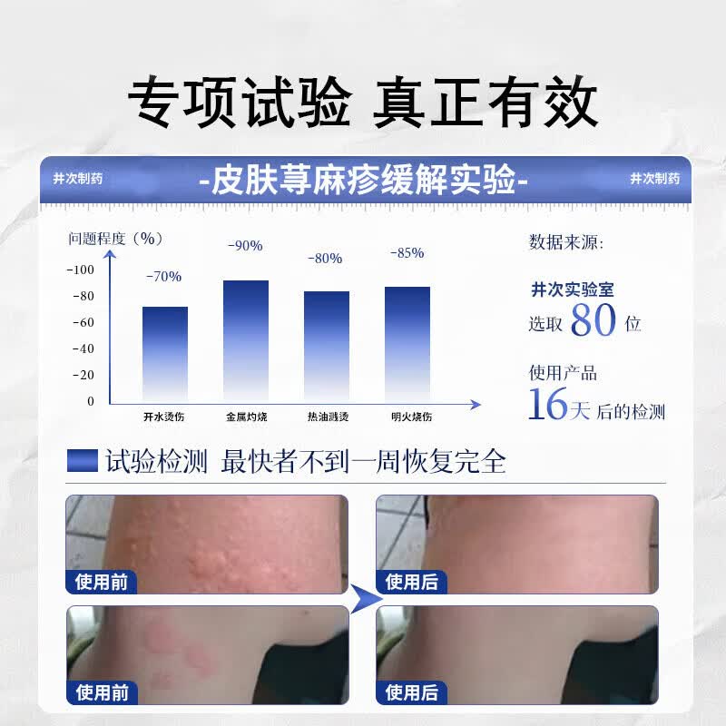 北京协和医学院荨麻疹进口药过敏止痒断i根增强免疫力荨麻疹药膏专用治疗急慢性 1盒装【北京协和】 过敏止痒软膏丘疹性荨麻疹专用