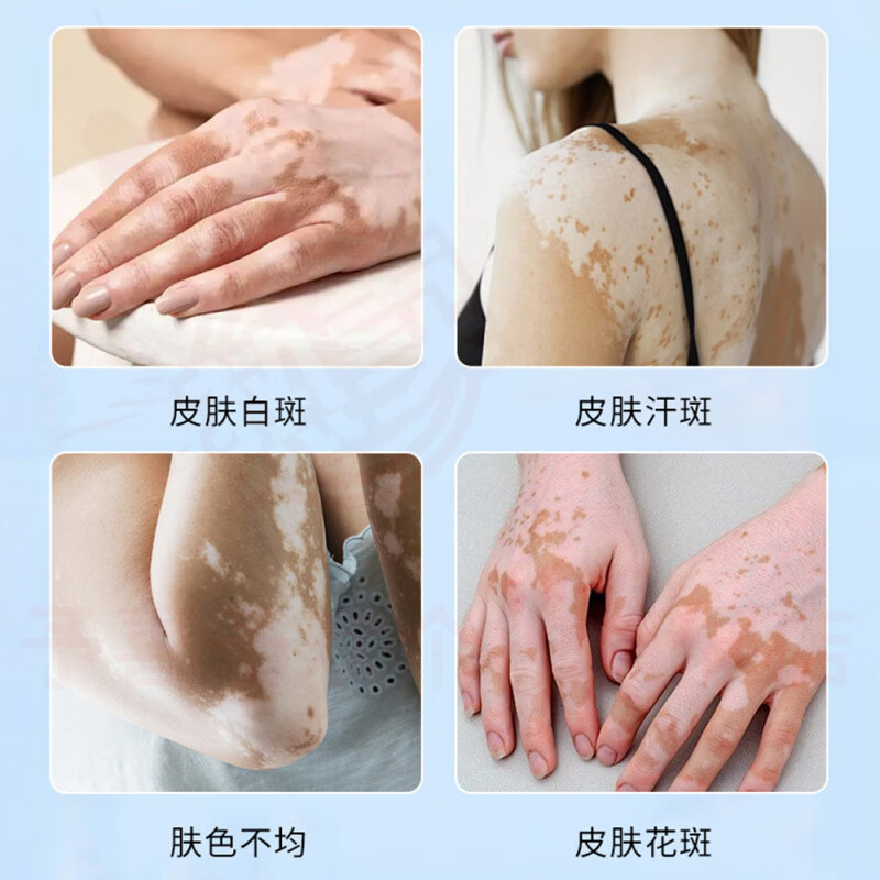 鹿角卉乳膏花斑白斑汗斑白肤色不均护理膏身体护肤外用膏 5瓶【巩固装】 官方自售