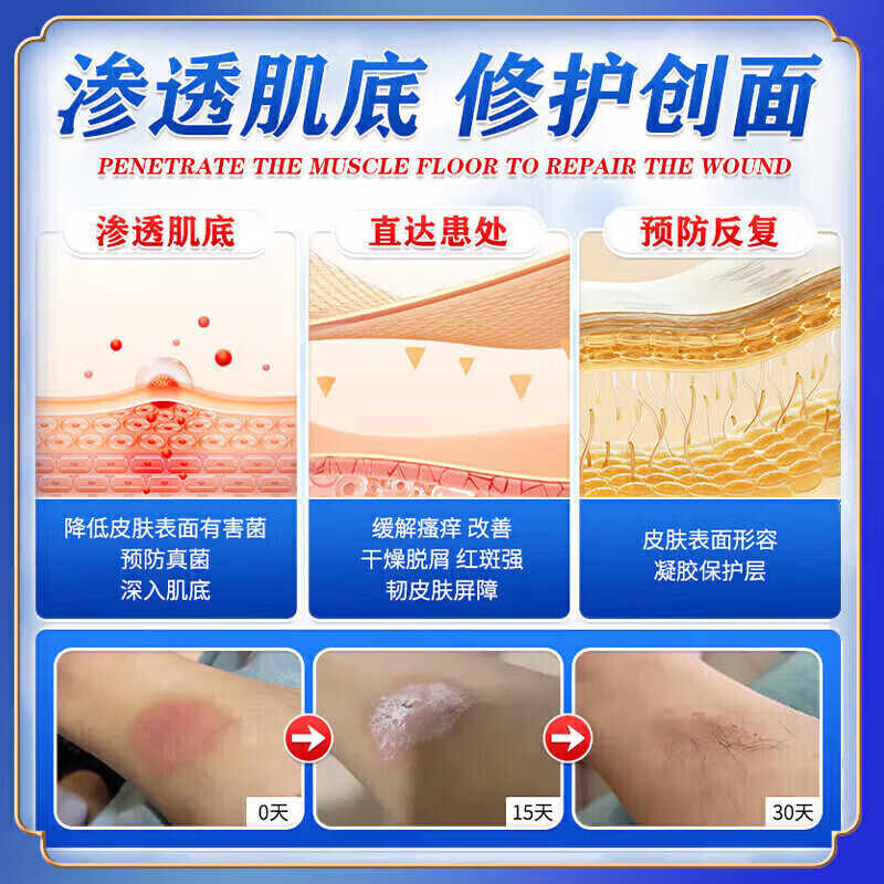 北京协和医学院牛皮癣断根药皮肤癣膏药真菌止痒抑菌皮肤顽固牛皮癣i药膏进口 特强效3盒【500%必裉除】 银屑病牛皮癣皮肤癣专用特强效膏