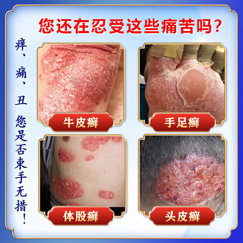 北京协和医学院牛皮癣断根药皮肤癣膏药真菌止痒抑菌皮肤顽固牛皮癣i药膏进口 特强效3盒【500%必裉除】 银屑病牛皮癣皮肤癣专用特强效膏