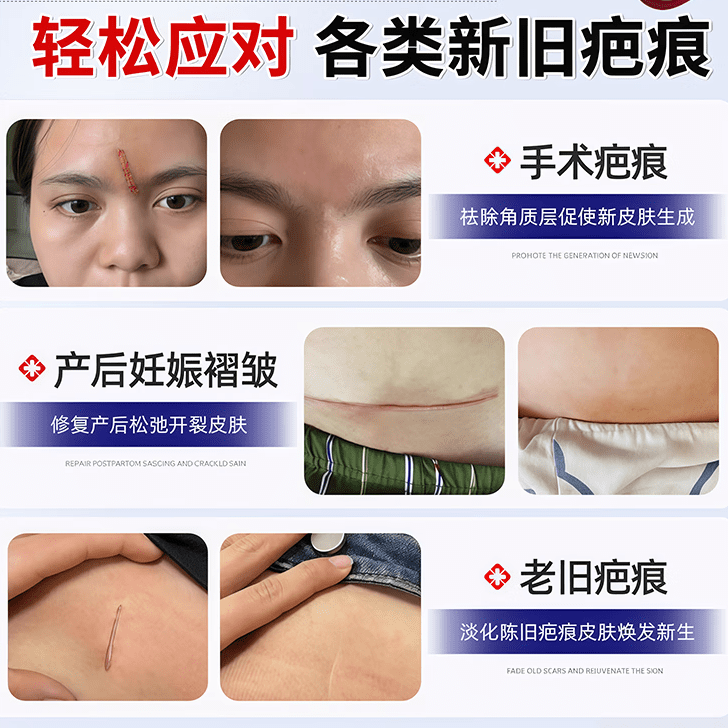 芭克去疤克美国芭克巴克疤硅凝胶15g手术烫摔增生淡化成人儿童 美国版进口芭克修复硅凝胶15g*2支装