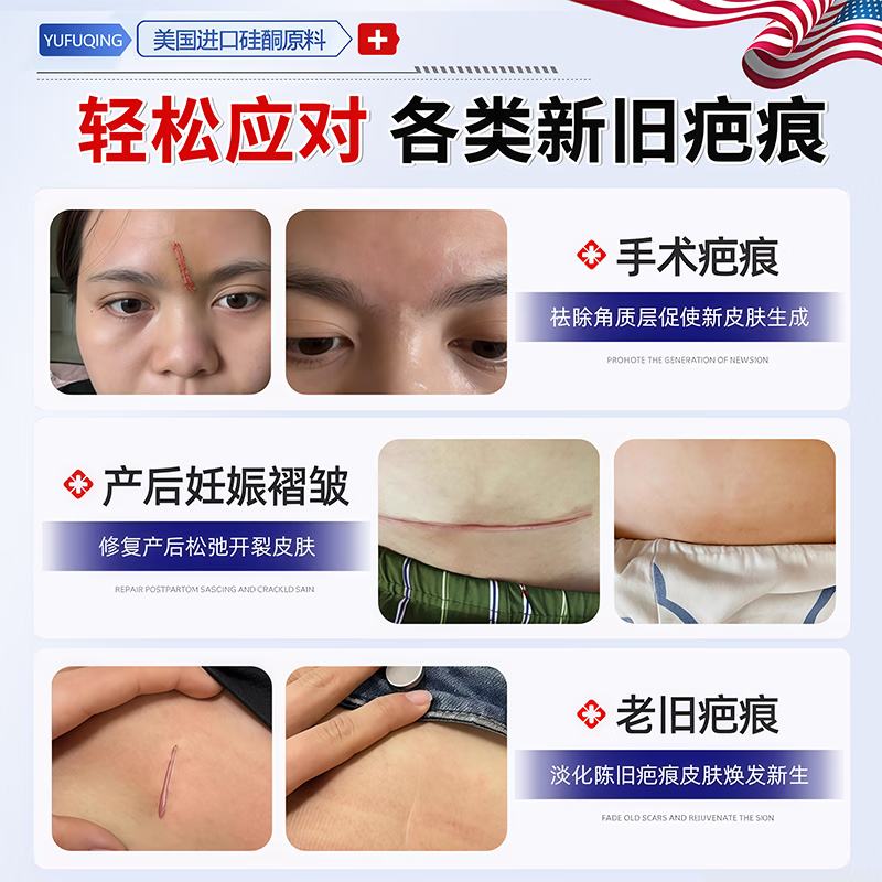 芭克疤巴克祛疤膏美国进口去疤痕修复正品凝胶剖腹产烫伤药膏儿童专用 特效五盒[强烈推荐家庭备用15g*5