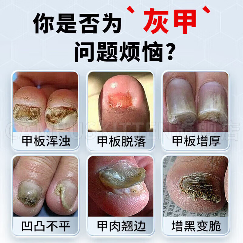 BEIYVS甲贝诺灰甲灰甲保健擦剂专用浑浊坏甲厚变黄真菌感染脱甲官方 1盒【体验见效装】 【官方直售】