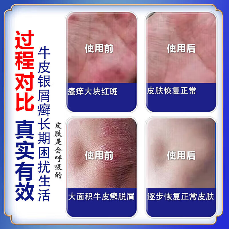 北京协和医学院牛皮癣断根药皮肤癣膏药真菌止痒抑菌皮肤顽固牛皮癣i药膏进口 特强效3盒【500%必裉除】 银屑病牛皮癣皮肤癣专用特强效膏