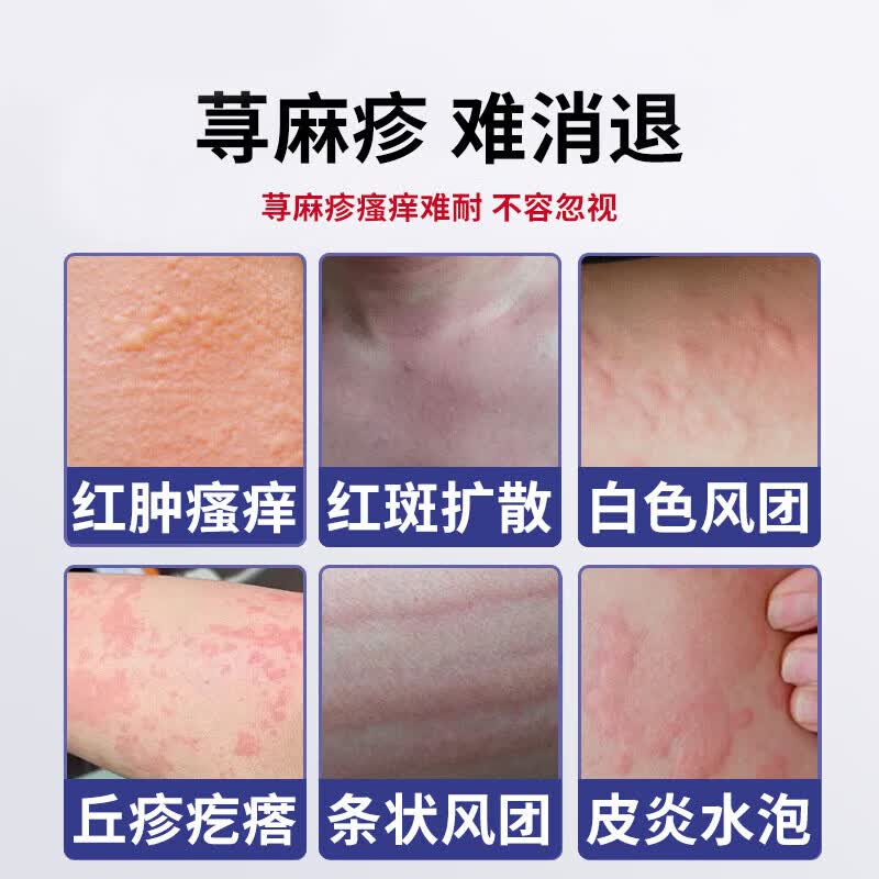 北京协和医学院荨麻疹进口药过敏止痒断i根增强免疫力荨麻疹药膏专用治疗急慢性 1盒装【北京协和】 过敏止痒软膏丘疹性荨麻疹专用