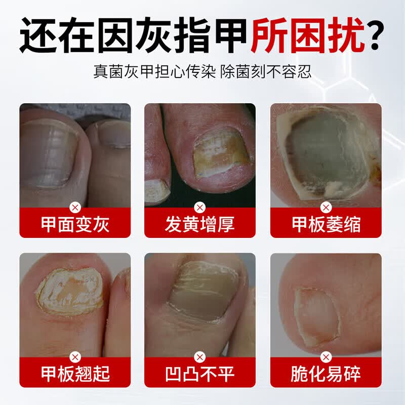 国药药材灰指甲第1名药灰指甲专用指甲真菌感染脱甲坏甲新亮甲根i治抑菌液 1盒装【1-2个推荐】 灰指甲100%特效专用的药第一名