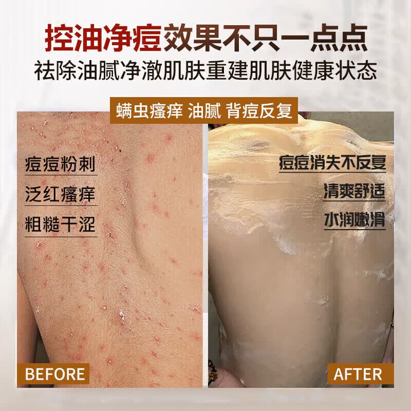 国药精养硫磺皂除螨沐浴露控油止痒杀菌螨虫痘男女洗脸洗头洗澡三合一 一瓶装400ml