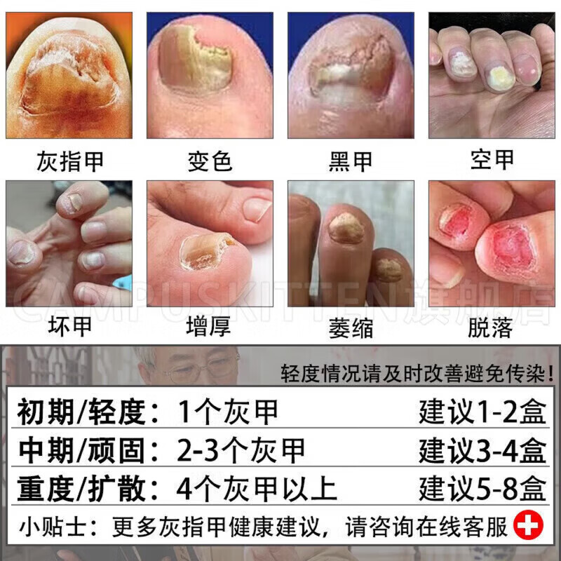 BEIYVS甲贝诺灰甲灰甲保健擦剂专用浑浊坏甲厚变黄真菌感染脱甲官方 1盒【体验见效装】 【官方直售】