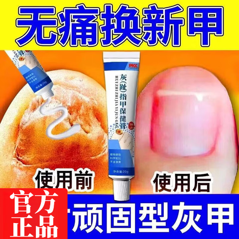 御灵花灰指甲发黄增厚软甲坏甲空甲萎缩甲变色男女适用专用护理膏 1支装【体验发正装】 【官方直售 京质保障】