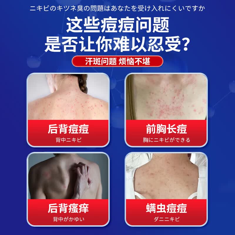 东田后背部长痘痘毛囊炎专用前胸背粒消祛痘止痒抑菌真菌感染药膏喷雾 一盒装【多买多送】发货特效快 毛囊炎真菌感染专用祛痘除螨喷雾剂