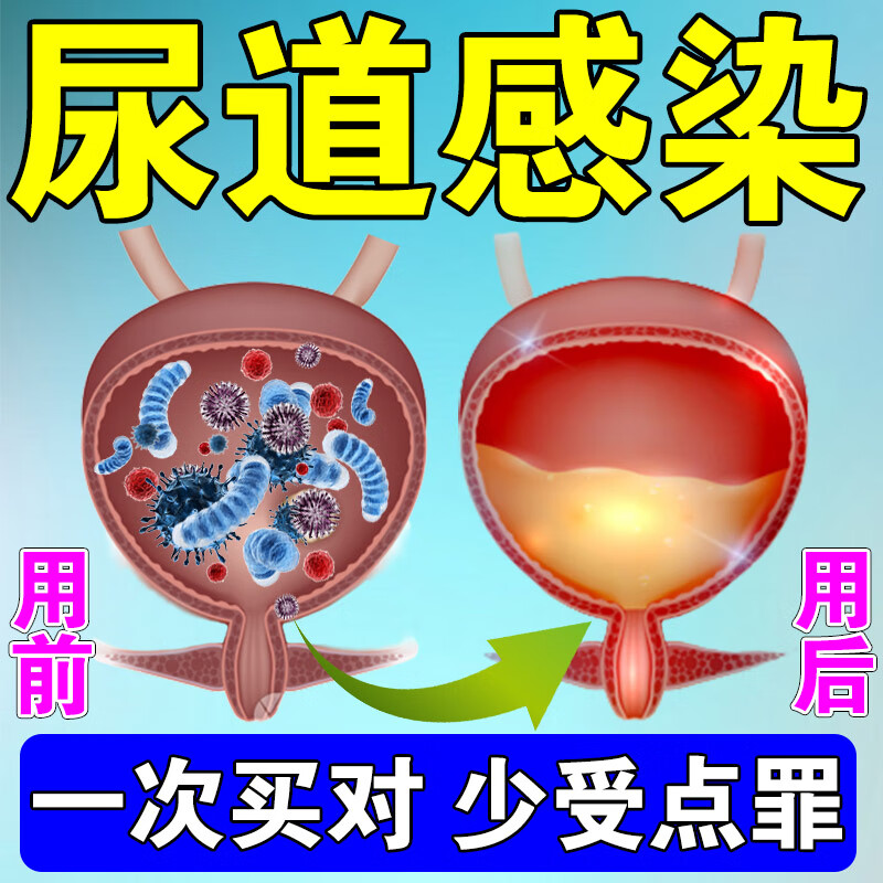 药房直售尿道i炎尿路i感染女反复发急性膀胱炎尿频尿急尿不尽排尿 单