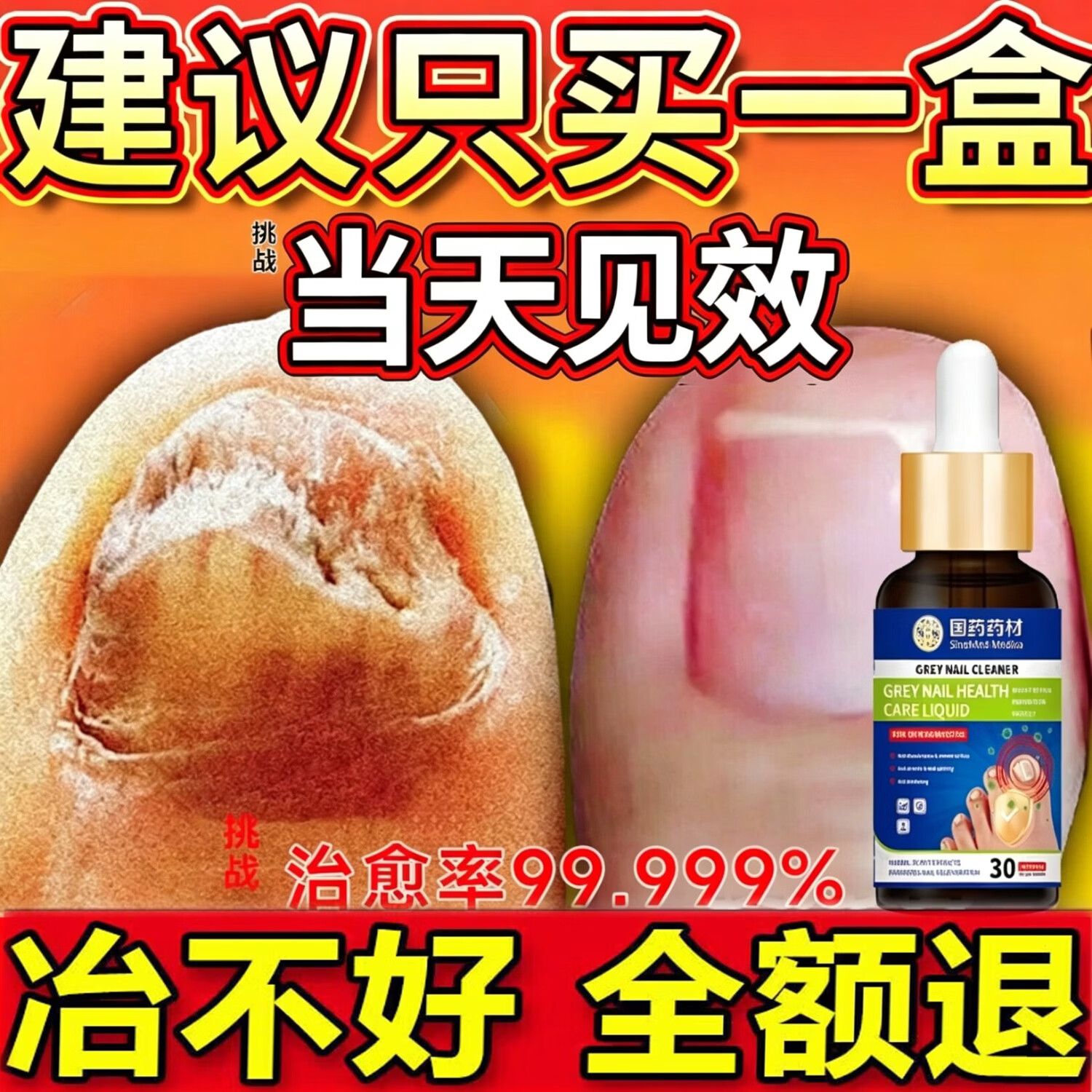 国药药材重度灰指甲100%特效专用的药特殊效专用抑菌液灰甲净套装 2-5个灰甲强荐【69%人选择】3盒