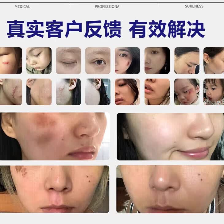 芭克去疤克美国芭克巴克疤硅凝胶15g手术烫摔增生淡化成人儿童 美国版进口芭克修复硅凝胶15g*2支装