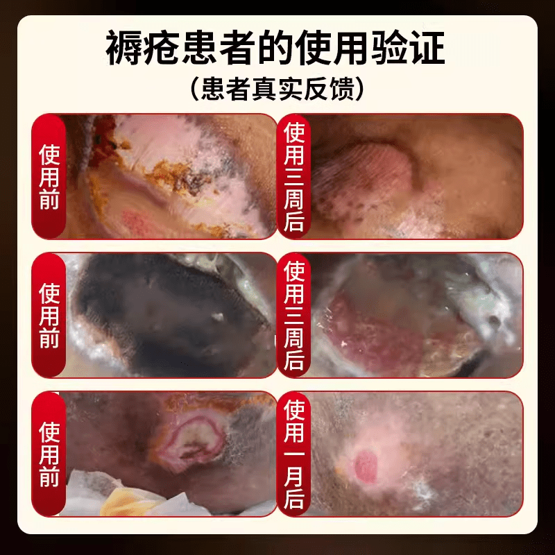 泥草氏橡皮生肌机膏天津达仁堂褥疮膏生肌膏长肉愈合伤口去腐老人臀部 超值装买3送2发五盒