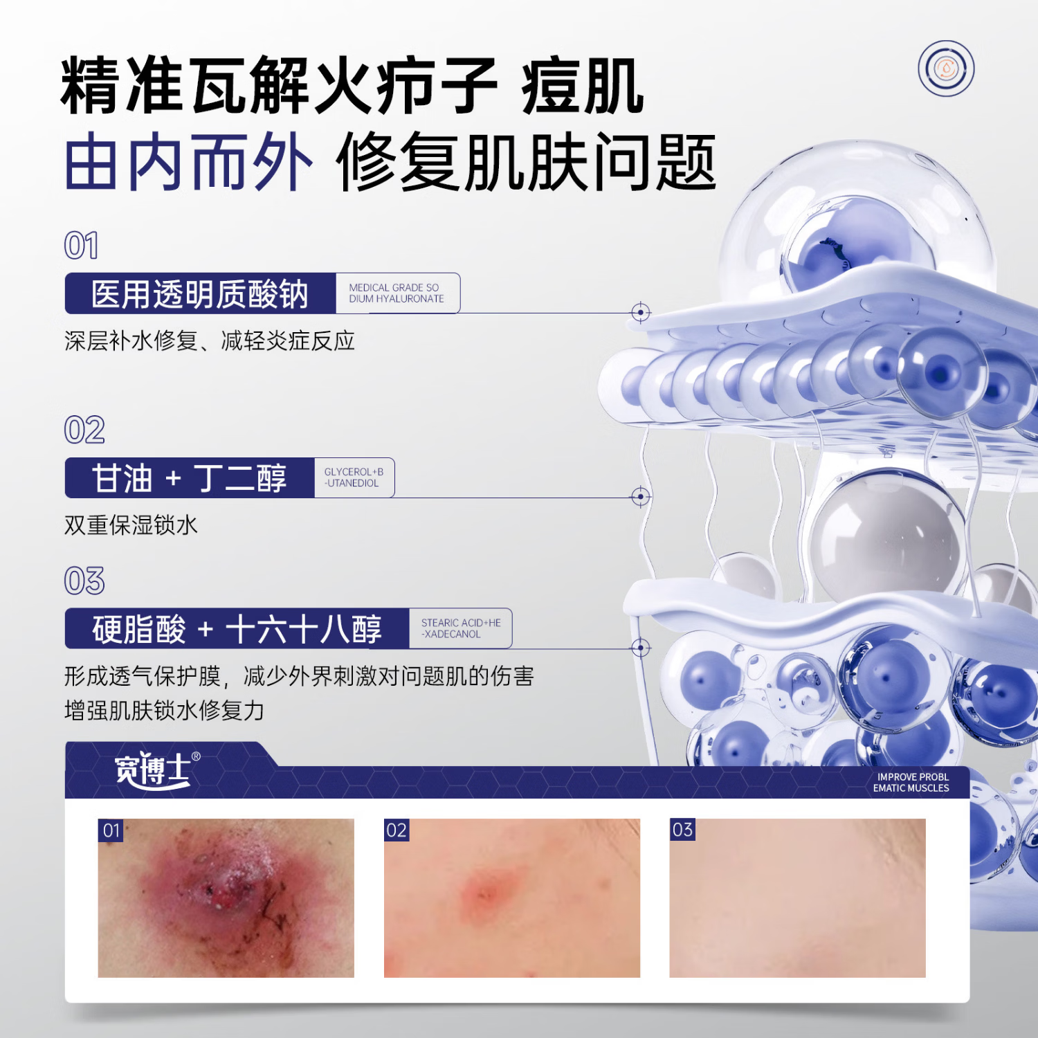 宽博士祛痘凝胶医用透明质酸钠修复软膏去火疖子改善痘痘 三盒【巩固装】