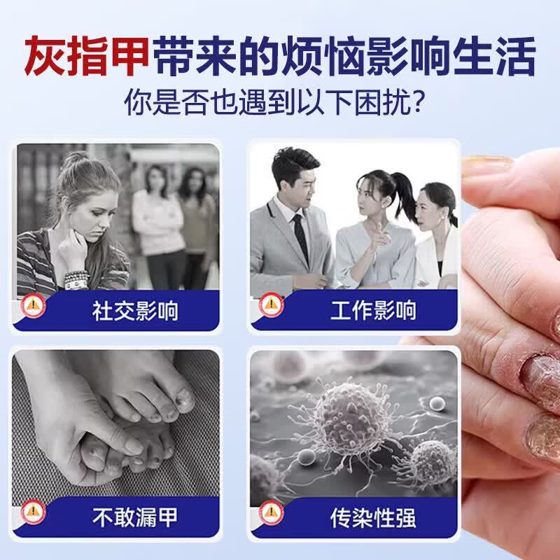 国药药材灰指甲第1名药灰指甲专用指甲真菌感染脱甲坏甲新亮甲根i治抑菌液 一盒【特效套装】1-2个灰甲选