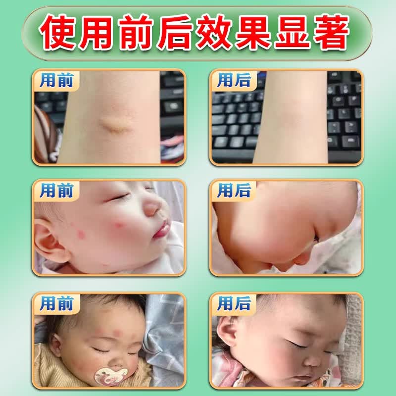 妙药堂夏季蚊虫叮咬止痒消肿婴儿100%止痒消肿药膏喷雾剂紫草膏露营神器 特效:九盒装【家庭必备】