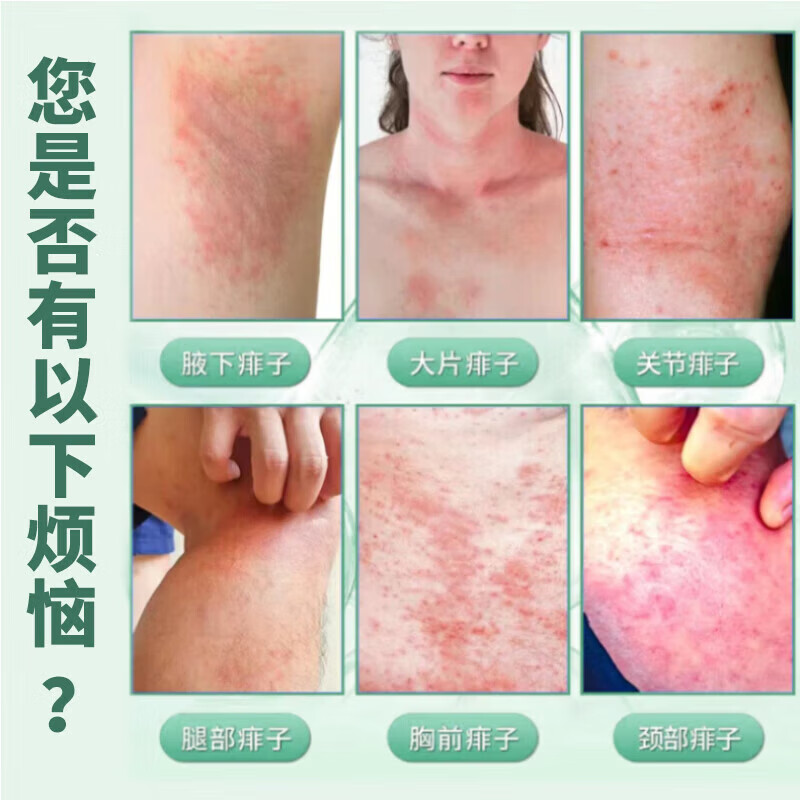 广雅痱子痒痱子水成人红痱子喷雾液体祛痱膏除热痱子水大人家中常备 三盒价发五盒