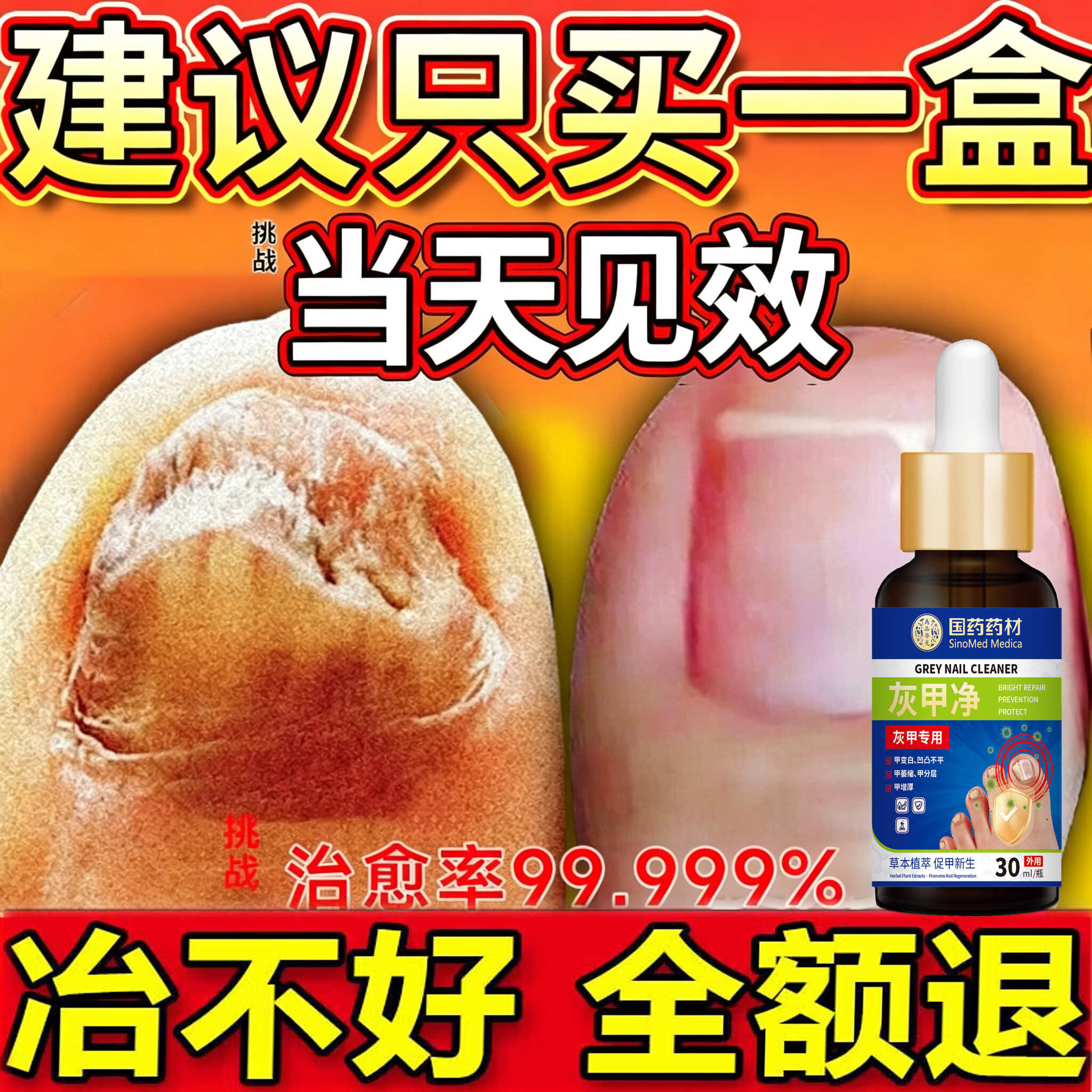 国药药材重度灰指甲100%特效专用的药特殊效专用抑菌液灰甲净套装 一盒【特效套装】1-2个灰甲选 灰指甲100%特效专用的药第一名