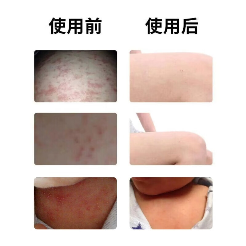 广雅夏季热痱子水祛痱止痒喷雾痱子粉婴儿专用止痒祛热痱子男士爽身粉 特效:买5送3【永不再范】