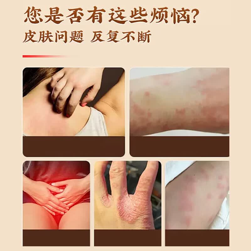 北京协和医学院止痒膏止痒抑菌皮肤瘙痒身体痒止痒特效湿炎皮疹真菌感染过敏药膏 单盒【皮肤瘙痒止痒祛湿毒】药膏 香港真菌王百草止痒王祛跟I湿毒清