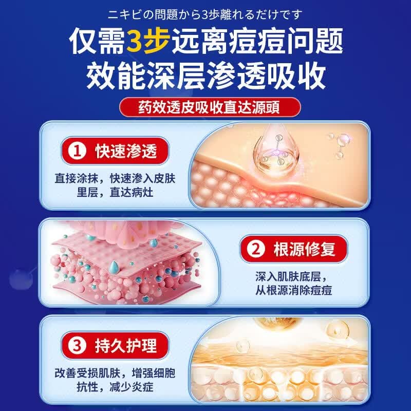 东田后背部长痘痘毛囊炎专用前胸背粒消祛痘止痒抑菌真菌感染药膏喷雾 一盒装【多买多送】发货特效快 毛囊炎真菌感染专用祛痘除螨喷雾剂