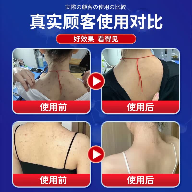 东田后背部长痘痘毛囊炎专用前胸背粒消祛痘止痒抑菌真菌感染药膏喷雾 一盒装【多买多送】发货特效快 毛囊炎真菌感染专用祛痘除螨喷雾剂