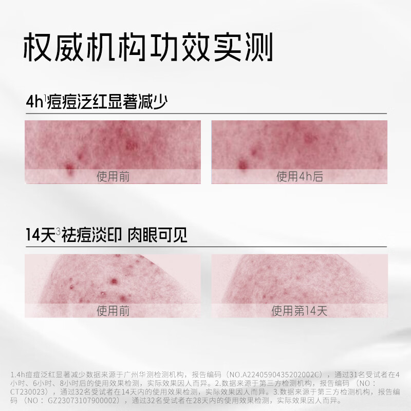 喜辽妥壬二酸祛痘精华霜红痘克星控油拔豆祛痘淡化红印防反复 壬二酸祛痘精华霜15g【20%浓度更强效】