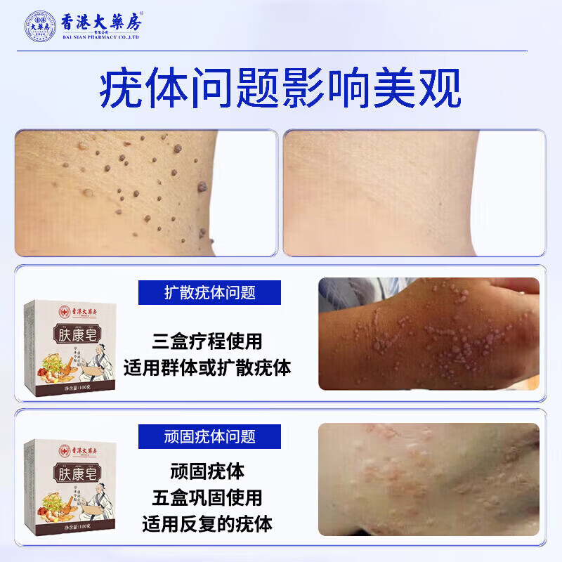 RSRDDY【一洗就掉】祛疣皂瘊尤皂猴子小肉粒痘痘粉刺清洁去尤香皂全身皂 一盒【初步祛无粒】26%客户选择