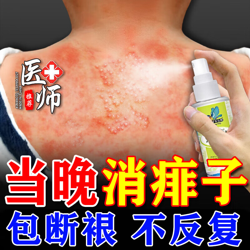 广雅夏季热痱子水祛痱止痒喷雾痱子粉婴儿专用止痒祛热痱子男士爽身粉 特效:买5送3【永不再范】
