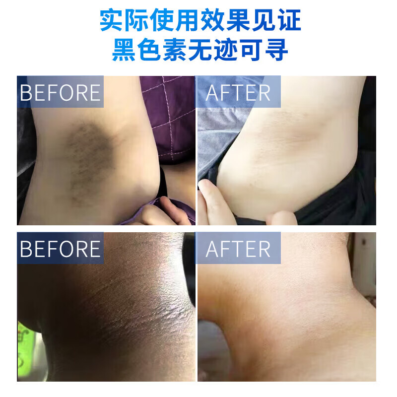 葵花胳膊肘黑色素沉淀去除手肘快速去黑淡化胳膊肘黑色素去黑去皮角质 【三盒】一抹转白
