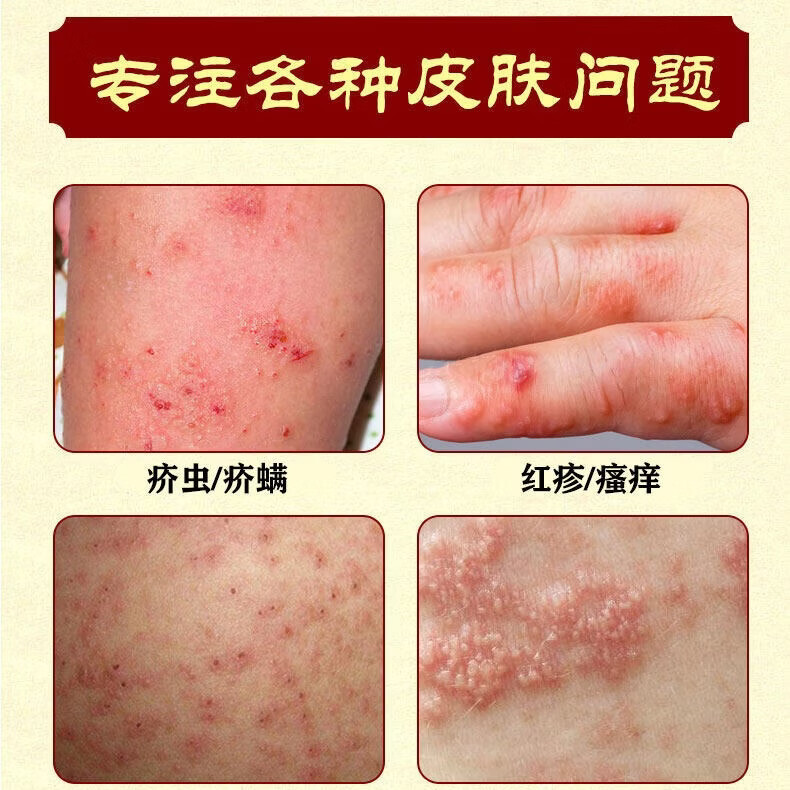 满力净疥疮药特效疥疮结节阴囊疙瘩私处皮肤瘙痒止痒疥螨虫专用硫磺软膏 15盒装-买10送5巩固装