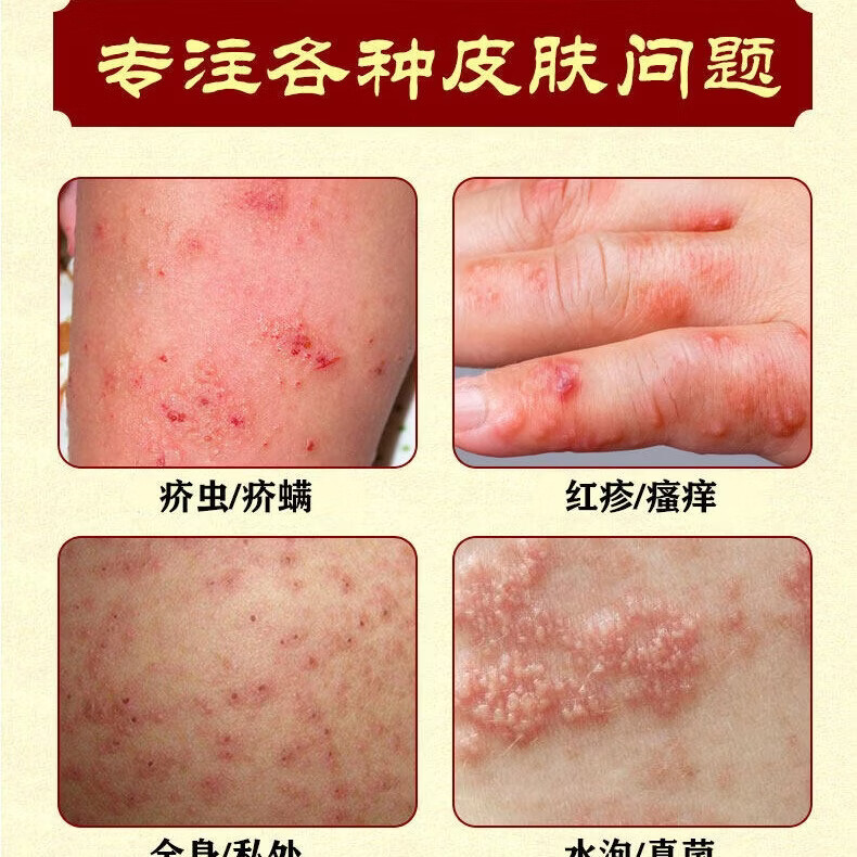 满力净疥疮药特效疥疮结节阴囊疙瘩私处皮肤瘙痒止痒疥螨虫专用硫磺软膏 15盒装-买10送5巩固装