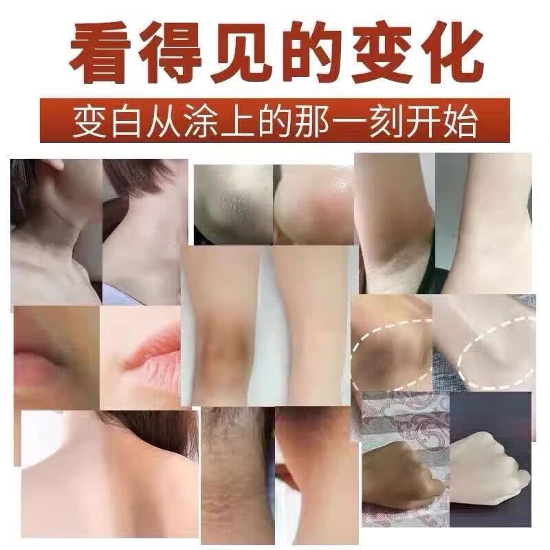 葵花胳膊肘黑色素沉淀去除手肘快速去黑淡化胳膊肘黑色素去黑去皮角质 【三盒】一抹转白