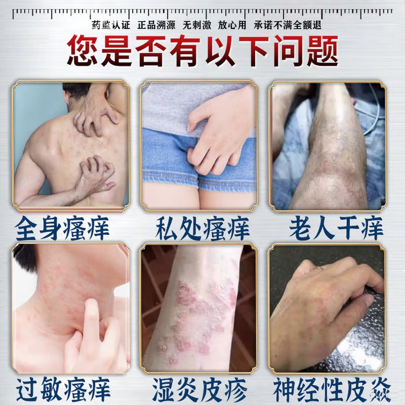 北京协和医学院止痒膏止痒抑菌皮肤瘙痒身体痒止痒特效湿炎皮疹真菌感染过敏药膏 1盒【皮肤瘙痒止痒去湿毒】药膏 香港真菌王百草止痒王祛根i湿毒清
