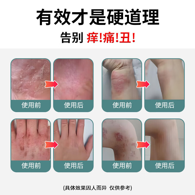 元氏立元堂草本抑菌小乳膏皮肤瘙痒皮炎湿疹体癣真菌感染皮肤外用止痒软膏 1盒 京东物流次日达·送货上门·正品保障·当日发货