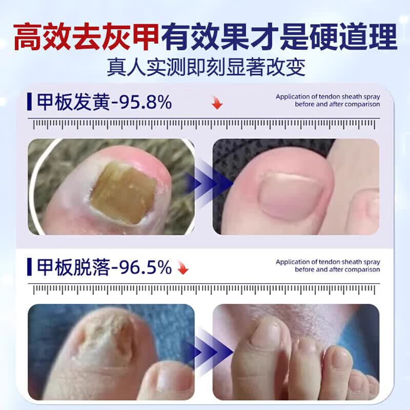 RSRDDY重度灰指甲100%特效专用的药特殊效专用抑菌液灰甲净套装 1盒【特效套装】1-2个灰甲选 灰指甲100%特效专用的药第一名