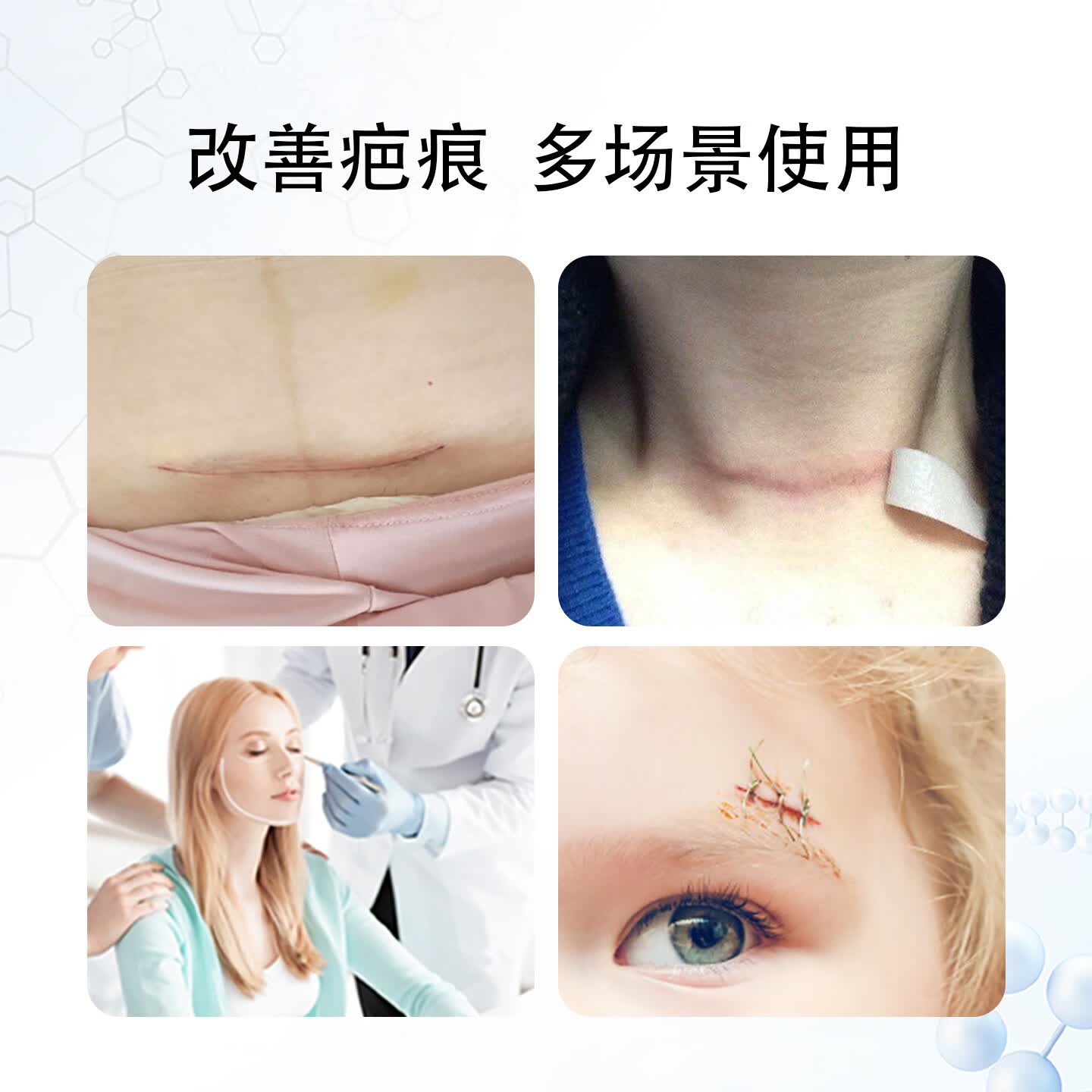 暨可复硅凝胶疤痕修复贴加厚疤痕贴剖腹产疤痕增生剖宫产手术疤痕贴疤 单盒装-送剪刀1+盐水1+固定胶带1+收纳盒1