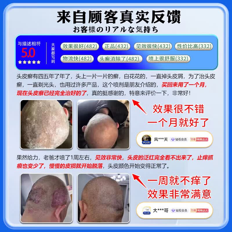 久研制药头癣头皮癣专用效喷剂真菌感染头皮屑瘙痒牛皮癣银屑病100%效去跟 药剂【100%根断】一瓶