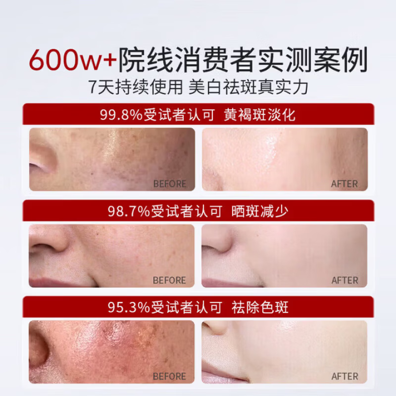 氟轻松氢醌维a乳膏三联医用级乳膏祛斑软膏淡化黑色素黄褐斑维a酸 特效三支【当晚就消斑】20g*3