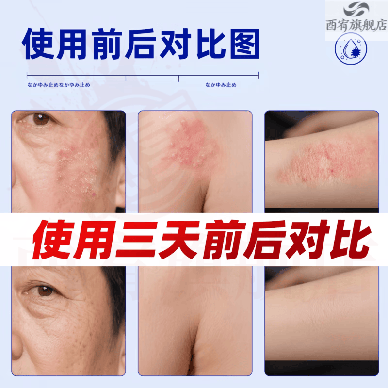 新适确得卤i米松三i氯生乳膏适用于脂溢性皮炎痒湿湿疹神经性皮炎抑菌止痒 1盒【见效装】  品牌自售