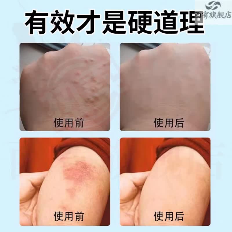 新适确得卤i米松三i氯生乳膏适用于脂溢性皮炎痒湿湿疹神经性皮炎抑菌止痒 1盒【见效装】  品牌自售