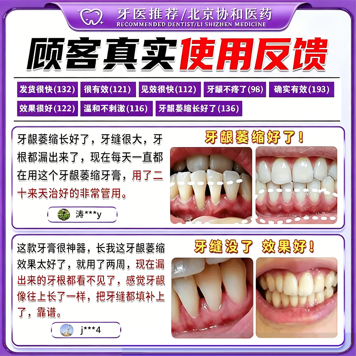 北京协和医学院萎缩牙龈i牙膏修复再生牙根外露专用牙膏护龈固齿牙龈i萎缩再生 【牙龈i萎缩】一盒 舒适达牙龈修复萎缩抗过敏松动