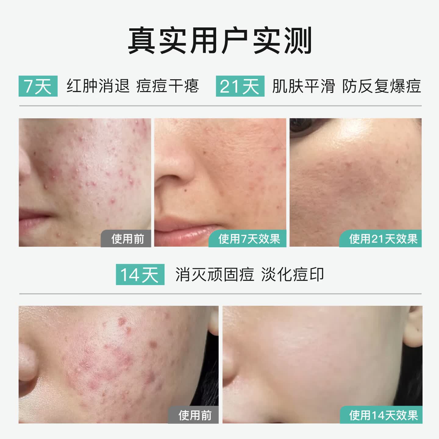 诺士博（NOVEXPERT）诺士博青少年祛痘精华液淡化痘印痘坑痘疤抗炎去粉刺去闭口急救笔 【8H速瘪痘】诺士博祛痘笔7ml